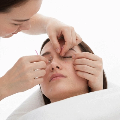 Augenakupunktur Behandlung